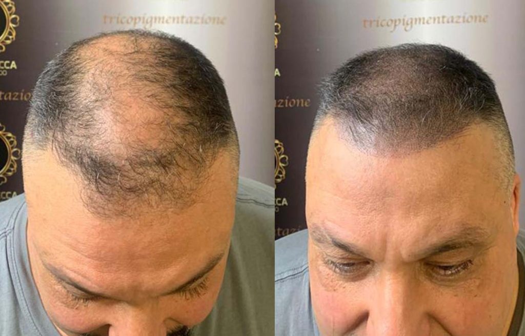 tricopigmentazione-rinfoltimento-capelli-zona-nucale-new-3-1